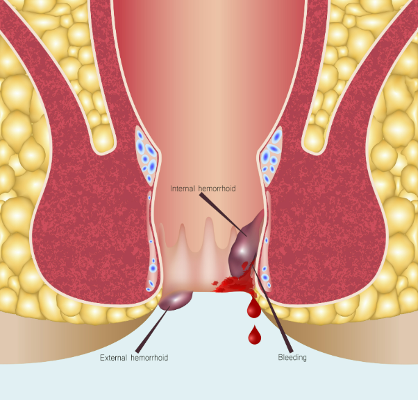 Haemorrhoids can be caused by increased strain in your bowel movements or constipation. Blood vessels can become varicose (enlarged) or even burst, causing bleeding and pain. However, it is important to make sure the bleeding is not due to other causes such as colon cancer, see a gastroenterologist to differentiate the causes of bleeding.